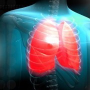 Tuberculosis related image